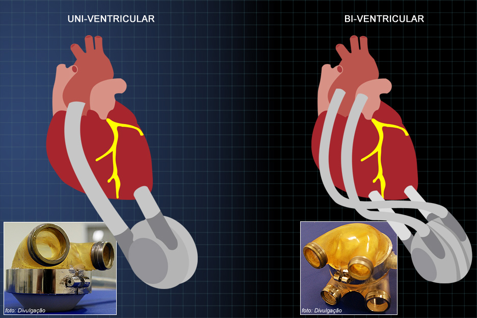 Coração artificial brasileiro