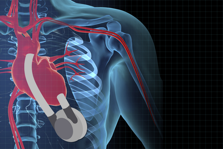 Coração artificial brasileiro