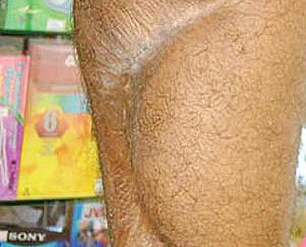Surfista atacado luta com tubarão